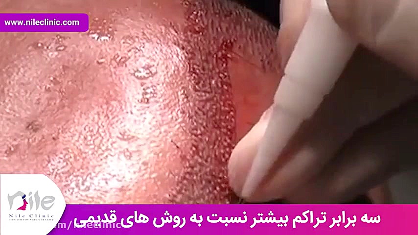 کاشت مو | فیلم کاشت مو | کلینیک پوست و مو نیل | شماره 16 pCO2