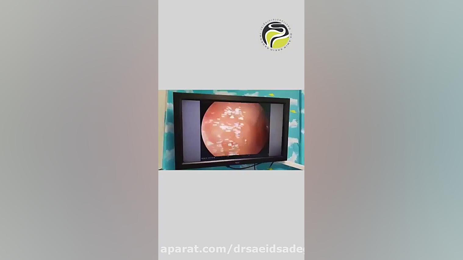 نکات مهم در حین کولونوسکوپی پر کردن دندان