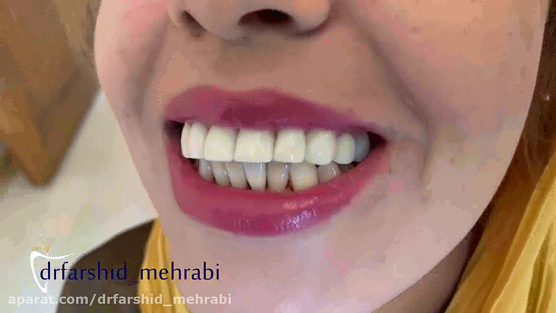 فیلم لمینت دندان، کامپوزیت دندان جراحی بینی