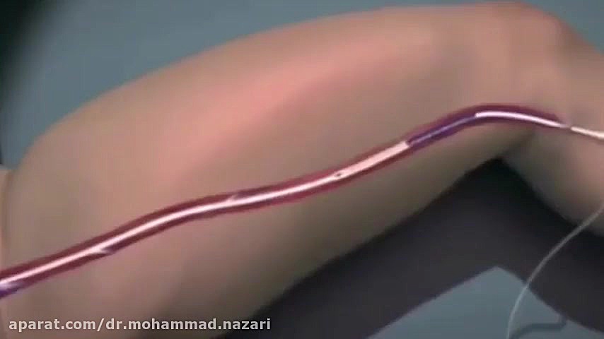 درمان واریس با لیزر و رادیوفرکانس دکتر محمد نظری-فوق تخصص اینترونشنال رادیولوژی