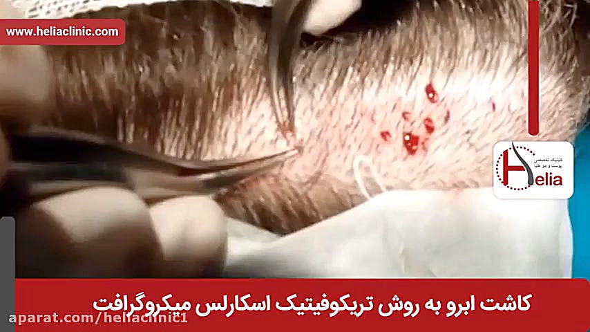 فیلم کاشت ابرو | کلینیک پوست و مو هلیا | 02179547 اصلاح طرح لبخند