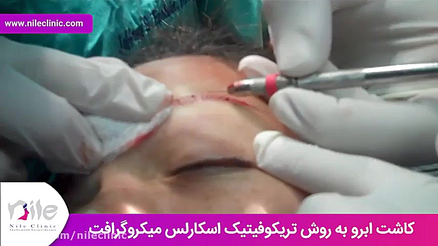 کاشت ابرو | فیلم کاشت ابرو | کلینیک پوست و مو نیل | شماره 16 پالبوسیکلیب