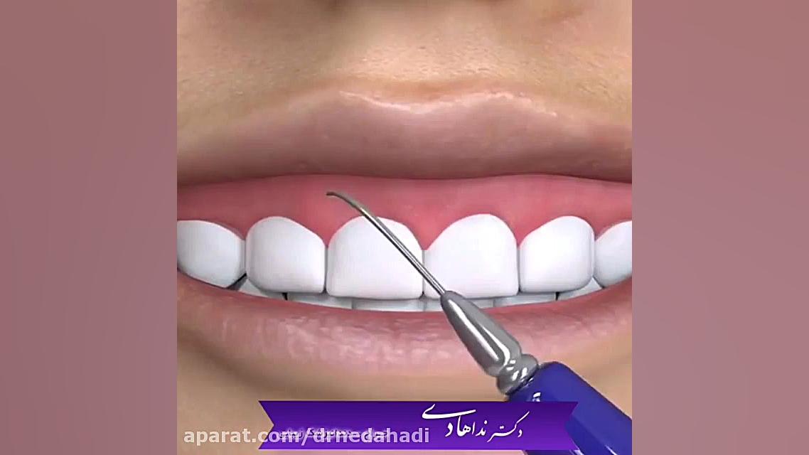 جراحی لبخند لثه دکتر ندا هادی-دندانپزشک زیبایی