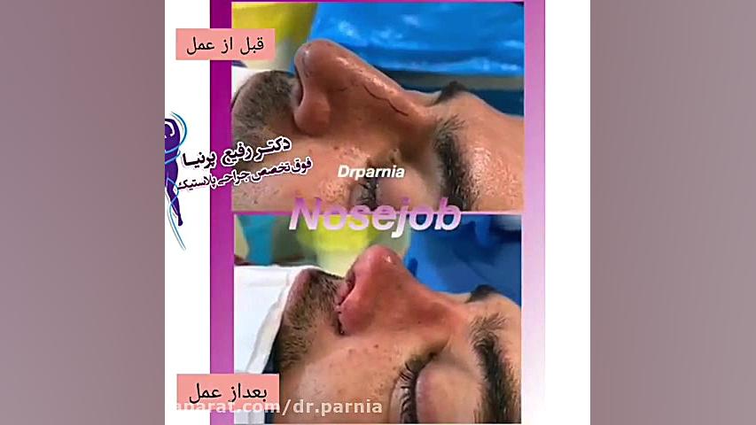 جراحی بینی گوشتی مردانه توسط دکتر رفیع پرنیا دکتر رفیع پرنیا فوق تخصص پلاستیک