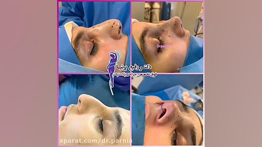 جراحی زیبایی بینی توسط دکتر رفیع پرنیا دکتر رفیع پرنیا فوق تخصص پلاستیک