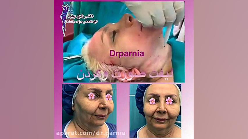 لیفت صورت و گردن توسط دکتر رفیع پرنیا TWA