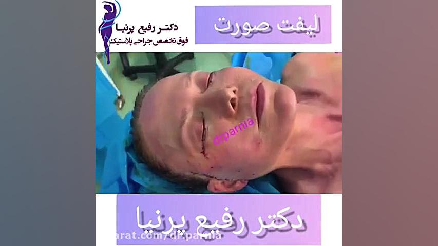 لیفت صورت توسط دکتر رفیع پرنیا ریژنراتیو مدیسین
