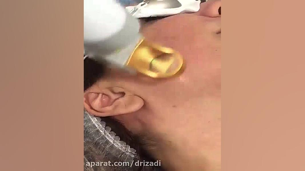 لیزر جنسیس دکتر مهدی ایزدی