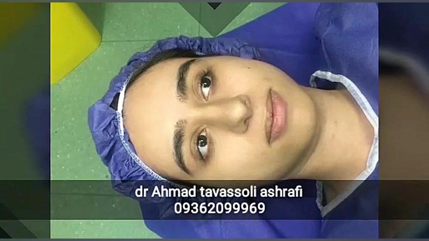 جراحی زیبایی بینی جراحی بینی دکتر احمد توسلی اشرفی