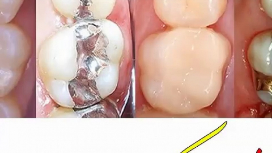 انیمیشن نحوه پر کردن دندان سندرم تریشن-کولینز نادر