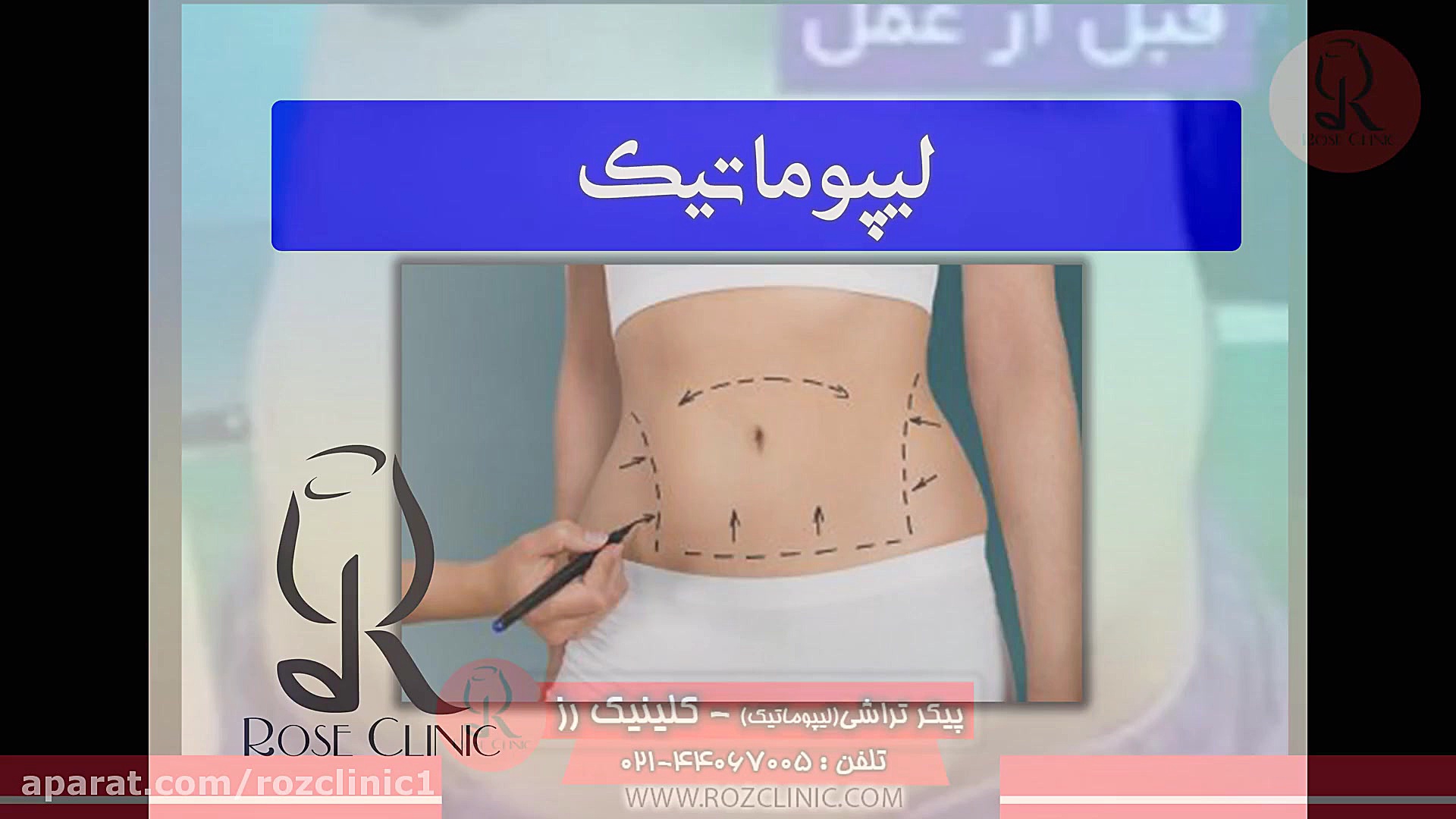 لیپوماتیک | فیلم لیپوماتیک | عمل لیپوماتیک | کلینیک پوست و مو رز | شماره 18 جراحی فک