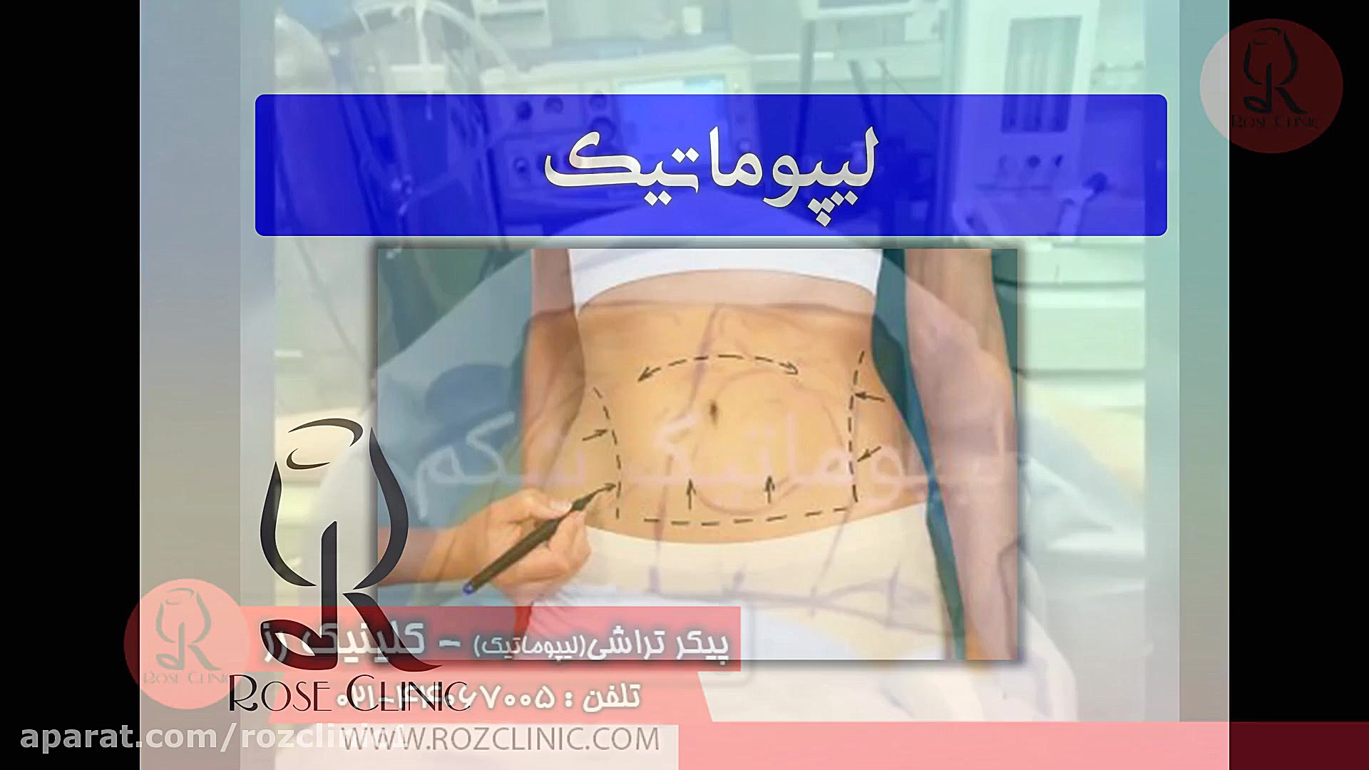 لیپوماتیک | فیلم لیپوماتیک | عمل لیپوماتیک | کلینیک پوست و مو رز | شماره 19 پزشکی تله‌مدیسین تخصصی