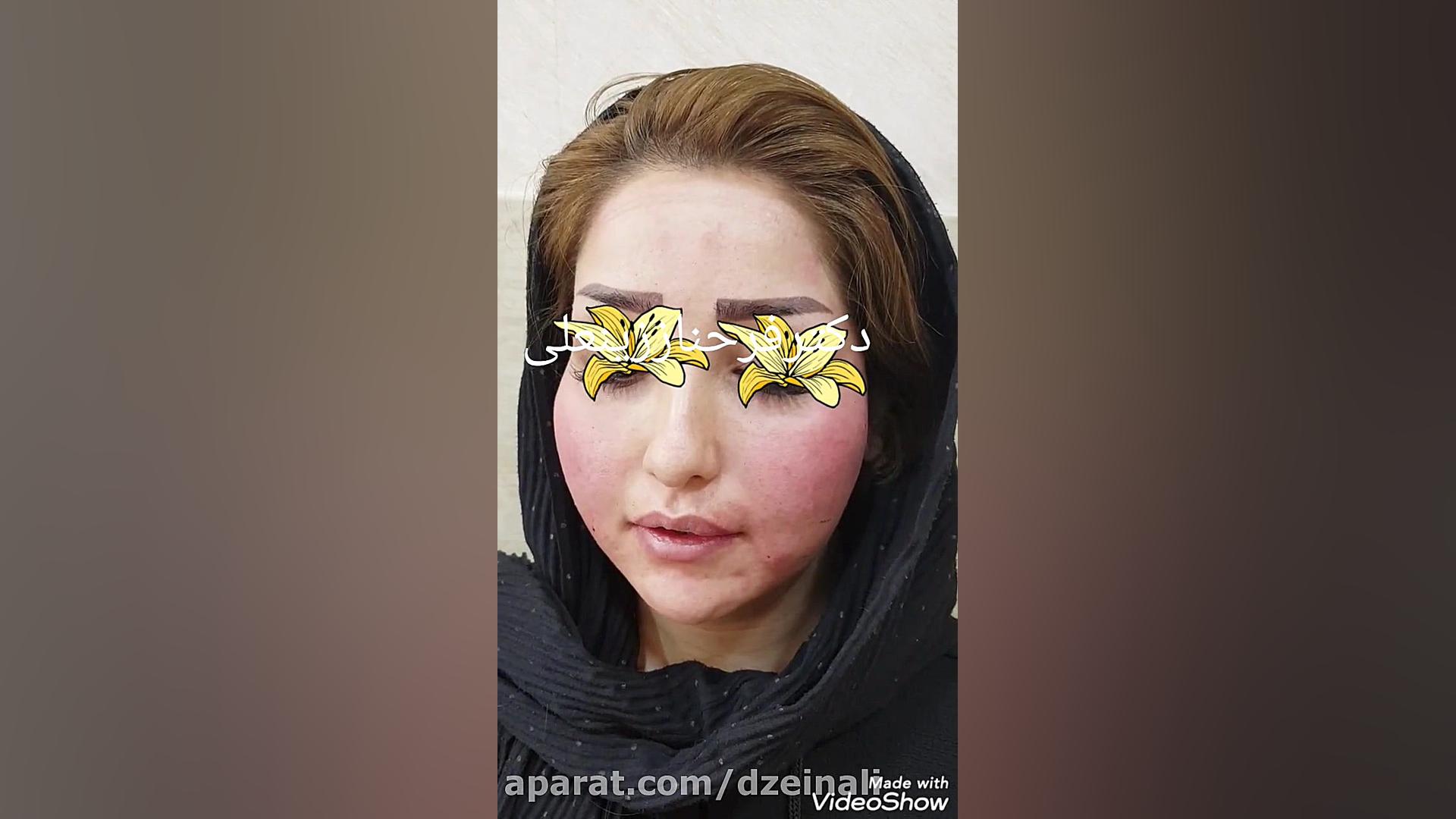 بلافاصله بعد از تزریق چربی مجدد دکتر فرحناز زینعلی - متخصص پوست، مو، زیبایی زنجان