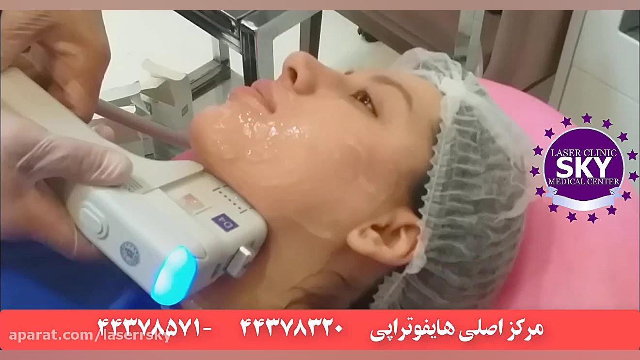 هایفوتراپی دندان شیری