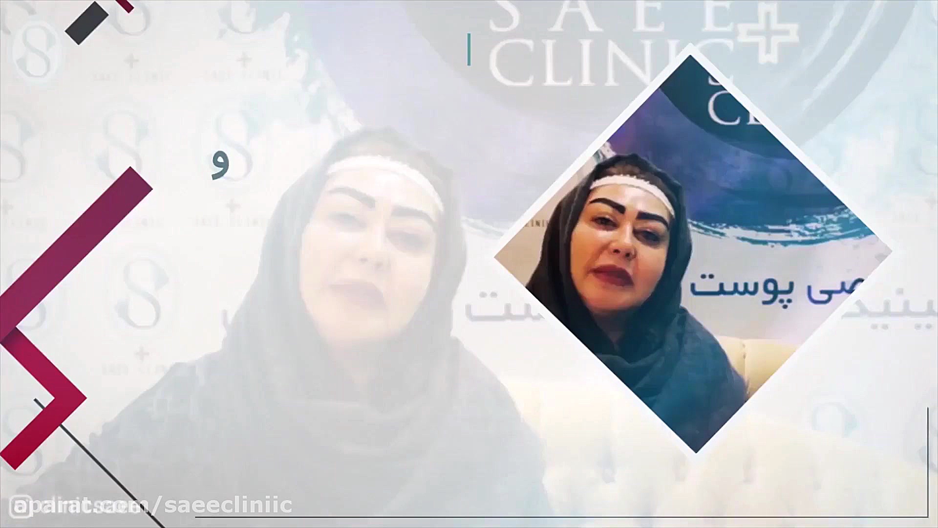 کاشت ابرو در دوران بارداری - کاشت ابرو طبیعی در کلینیک ساعی ربات جراحی داوینچی