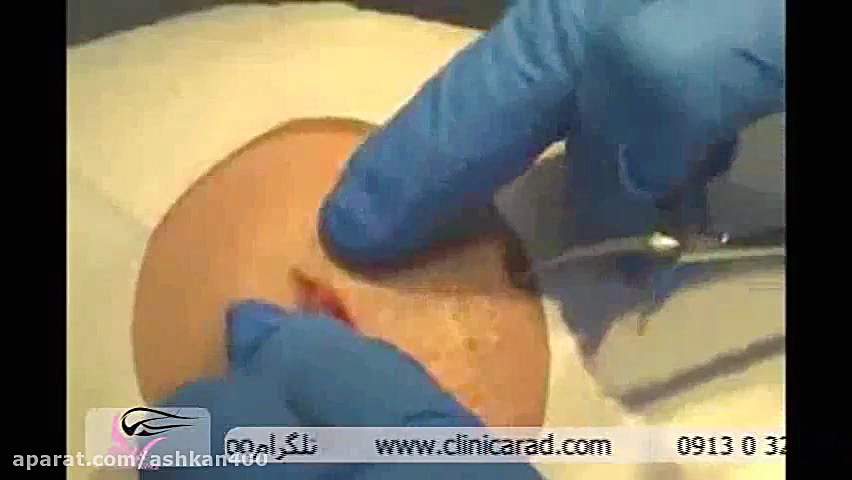 جراحی سرپایی جراحی پف زیر چشم