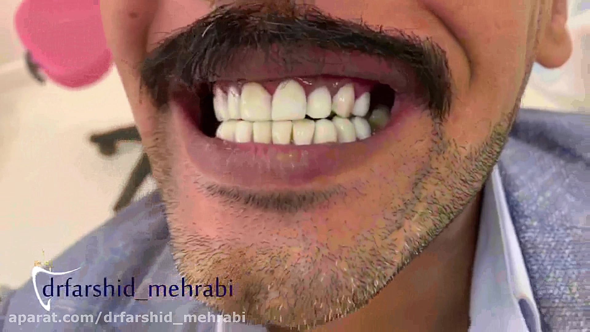 فیلم کامپوزیت دندان، کامپوزیت ونیر دندان نوروجراحی فانکشنال