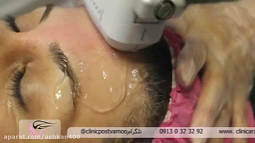 هایفوتراپی بیماری بهجت