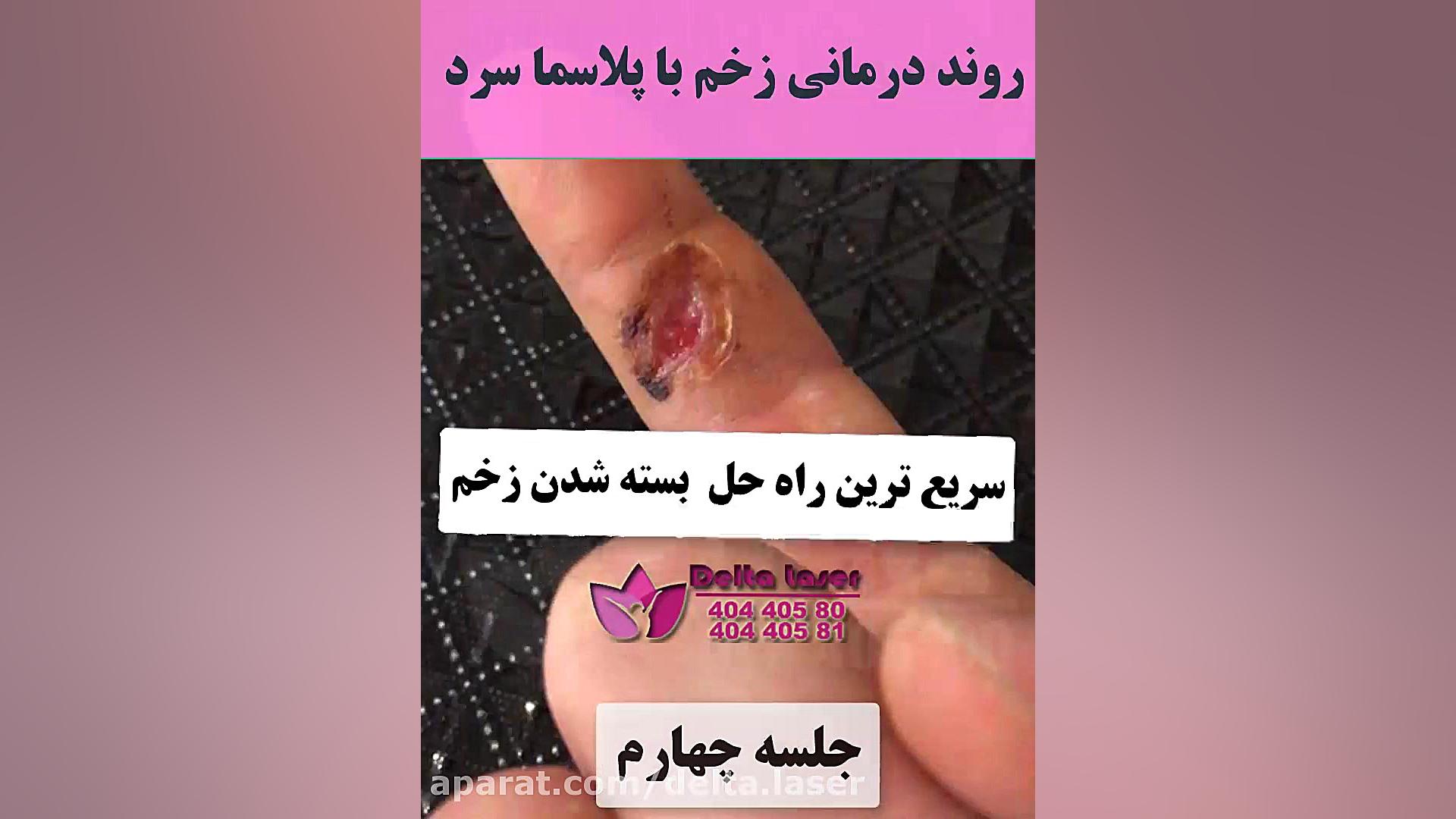 ترمیم زخم بدون درد با دستگاه پلاسما !! پلاسماجت