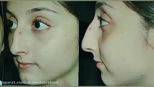 عمل بینی استخوانی توسط دکتر امید ابراهیمی بهترین جراح بینی استخوانی دکتر امید ابراهیمی