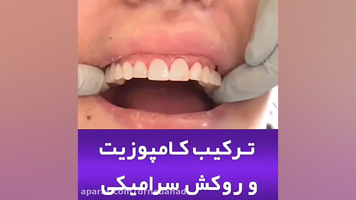 ترکیب کامپوزیت و روکش سرامیکی دکتر ندا هادی-دندانپزشک زیبایی