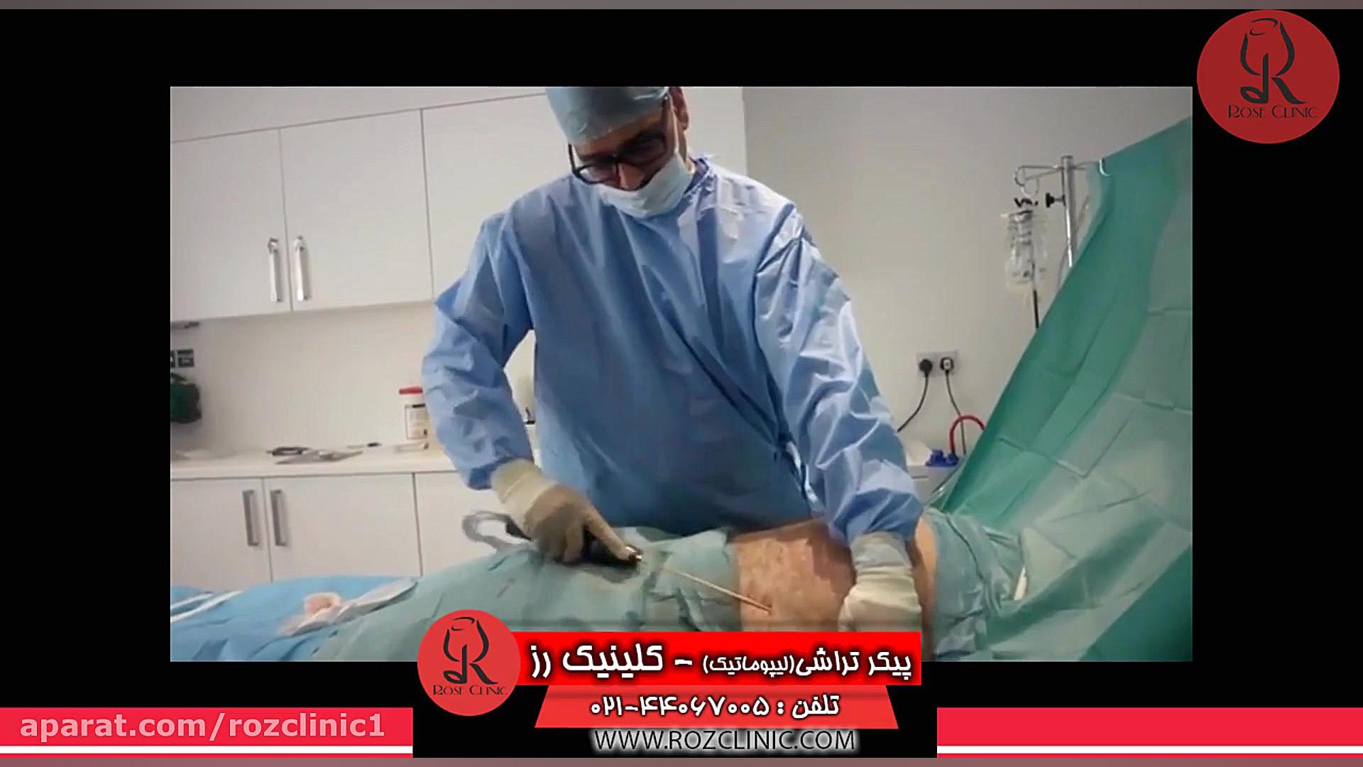 لیپوماتیک | فیلم لیپوماتیک | عمل لیپوماتیک | کلینیک پوست و مو رز | شماره 22 کاشت ابرو