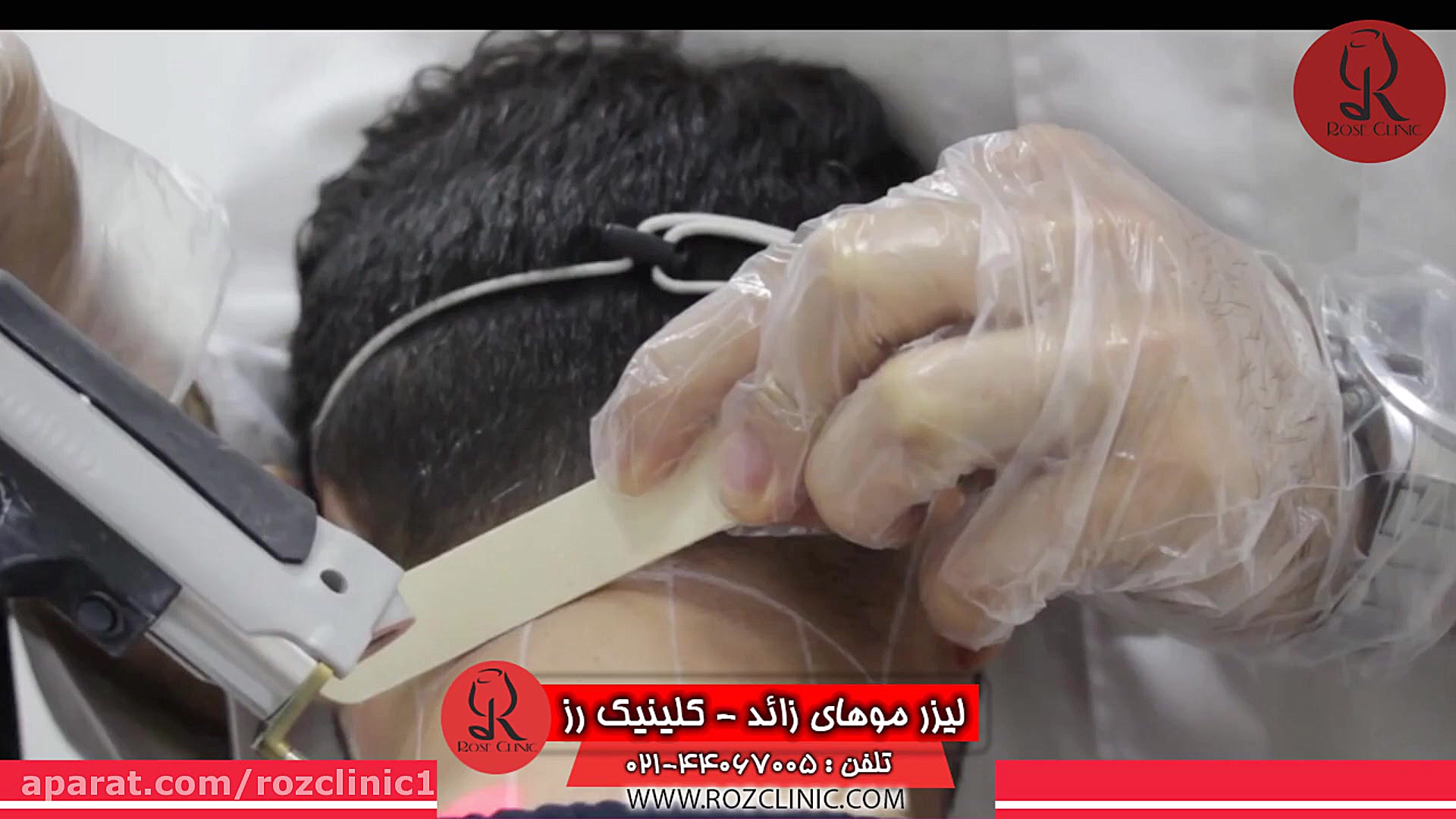 لیزر موهای زائد | لیزر مو | کلینیک پوست و مو رز | شماره 21 ماکروسفالی