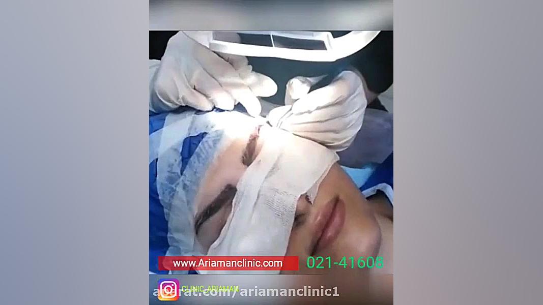 فیلم مراحل کاشت ابرو در کلینیک آریامن سیستم نانواینژکتور