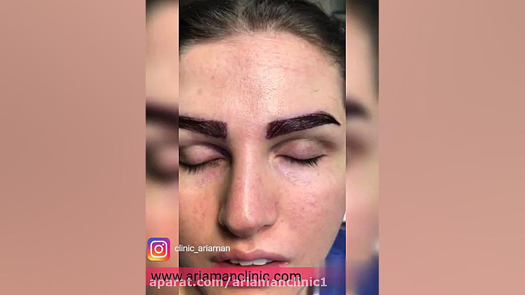 فیلم نمونه کاشت ابرو و نتیجه آن | کلینیک آریامن Spatial Transcriptomics