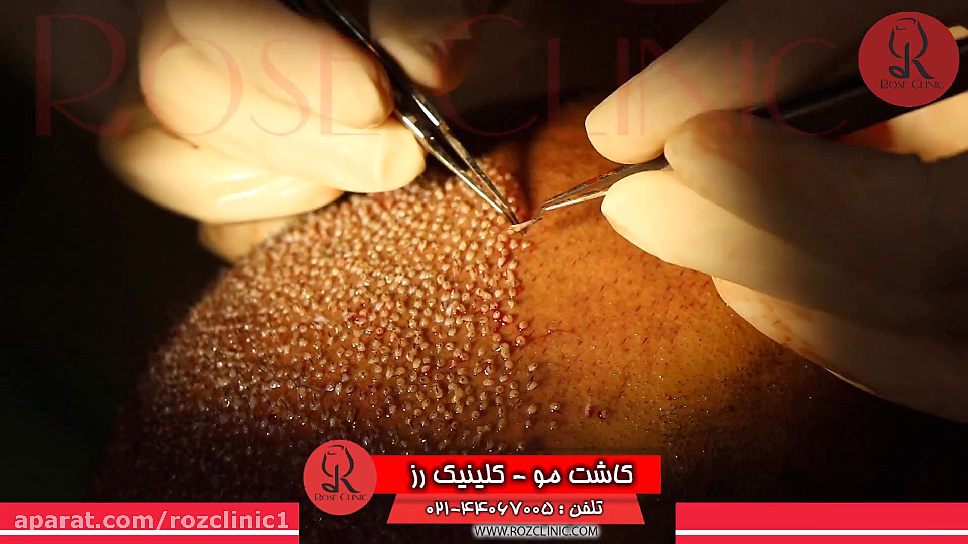 کاشت مو | فیلم کاشت مو | کلینیک پوست و مو رز | شماره 29 ارنیزوماب
