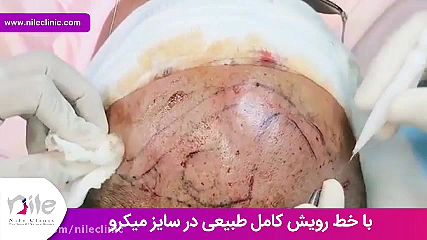 کاشت مو | فیلم کاشت مو | کلینیک پوست و مو نیل | شماره 19 بیماری گلوکوزامینوگلیکان تجمعی