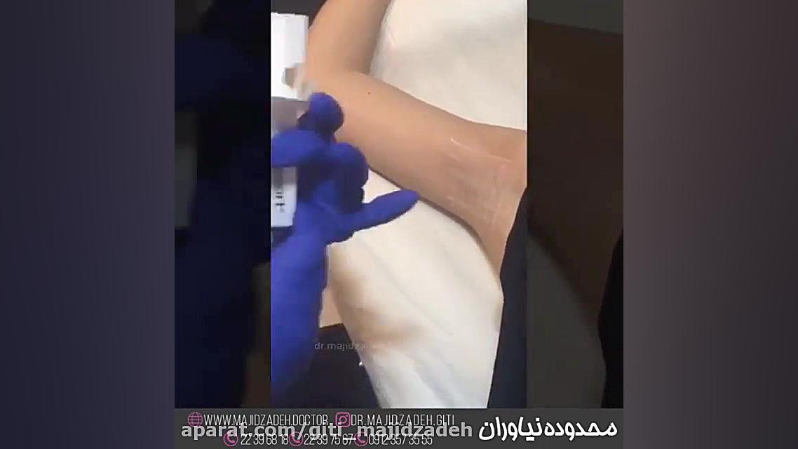 تزریق بوتاکس زیر بغل برای خلاص شدن از شر تعریق زیاد جراحی گوش