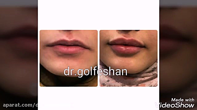 حجمدهی لب با فیلر لب توسط دکتر عاطفه گلفشان دکتر عاطفه گلفشان، متخصص پوست مو و لیزر درمانی
