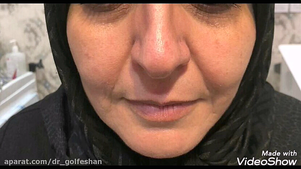 پلاسماجت بینی دکتر عاطفه گلفشان، متخصص پوست مو و لیزر درمانی