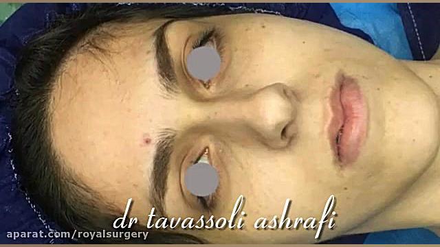 جراحی زیبایی بینی جراحی بینی دکتر احمد توسلی اشرفی