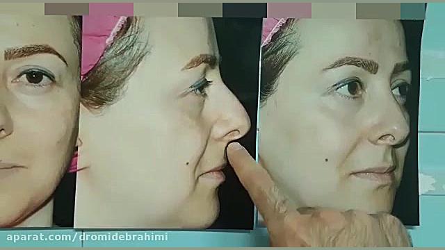 جراحی بینی گوشتی توسط دکتر امید ابراهیمی بهترین جراح بینی دکتر امید ابراهیمی