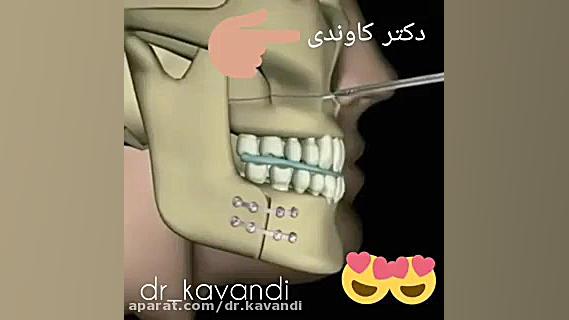 جراحی فک بالا و پایین | دکتر فرشید کاوندی پاکسازی پوست