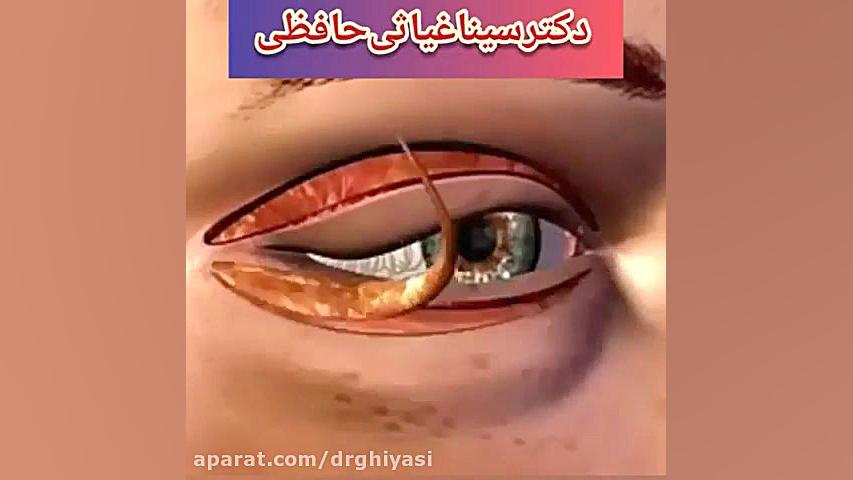 جراحی زیبایی پلک دکتر سینا غیاثی حافظی