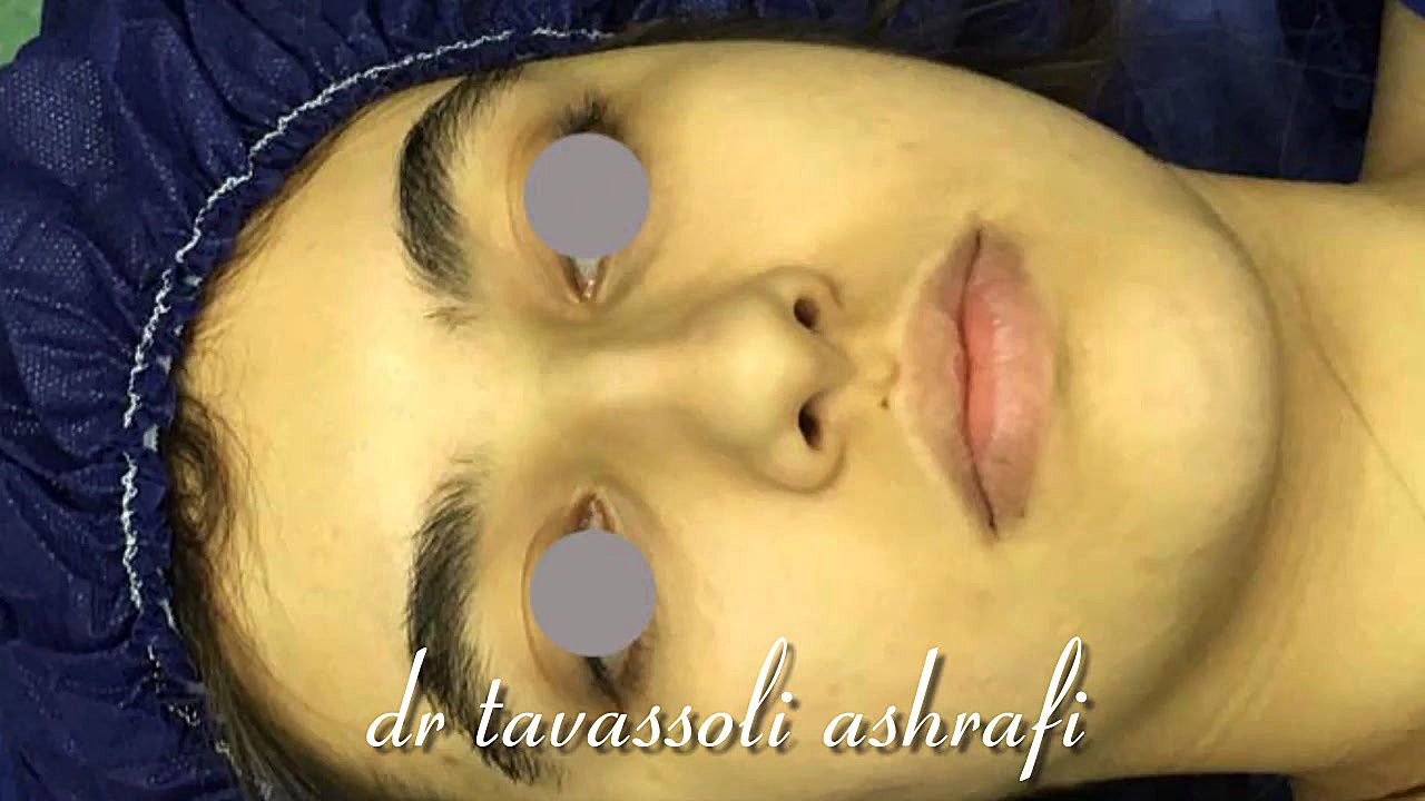 جراحی زیبایی بینی(بدون رد بخیه و برش) جراحی بینی دکتر احمد توسلی اشرفی