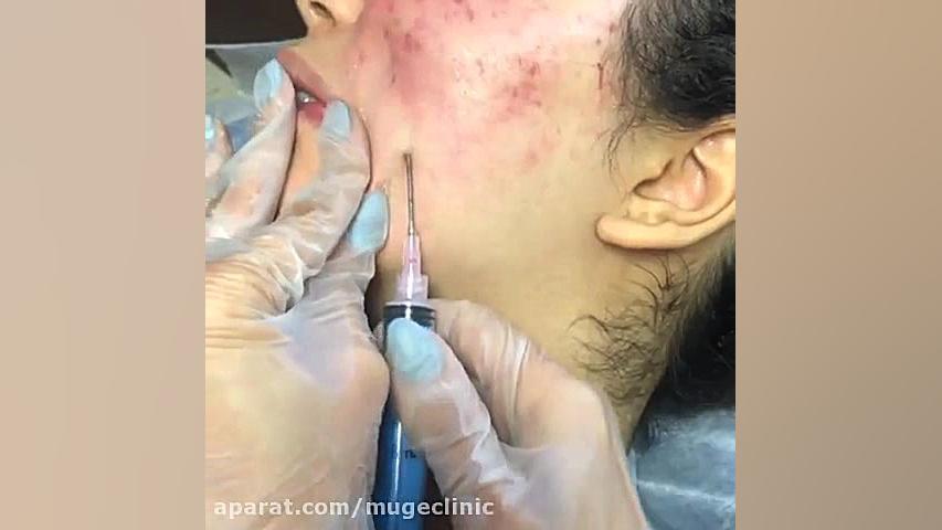درمان جای جوش صورت مزوتراپی