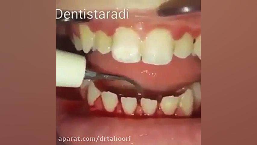 جرمگیری دندان - مرکز دندانپزشکی فوق تخصص ایمپلنت و زیبایی پردیس ویروس‌شناسی انسانی