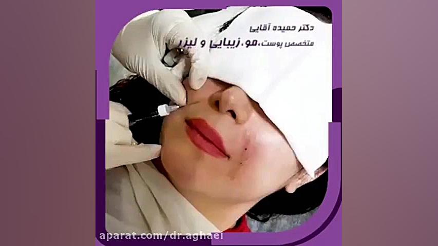 تزریق ژل برای اصلاح خط خنده تنها در یک جلسه دکتر حمیده آقایی