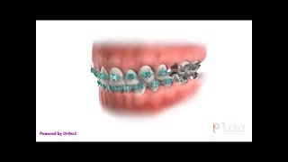 از بین بردن فضا به کمک ارتودنسی دکتر سهیل سالاری
