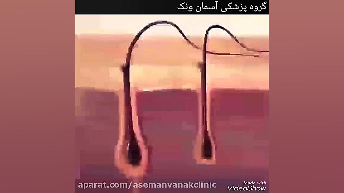 شیوه تاثیر لیزر بر فولیکول مو و ازبین بردن فولیکولهای موی در حال رشد اکتروپیون