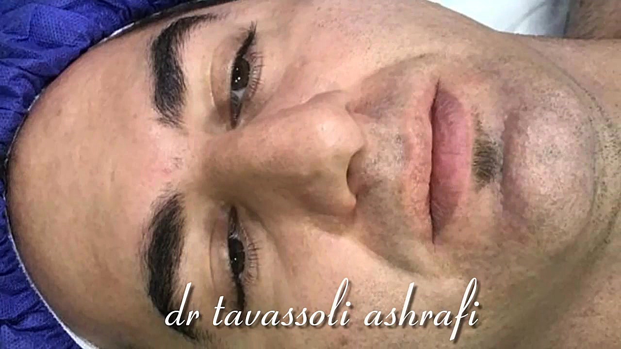 جراحی زیبایی بینی ( به روش باز) جراحی بینی دکتر احمد توسلی اشرفی