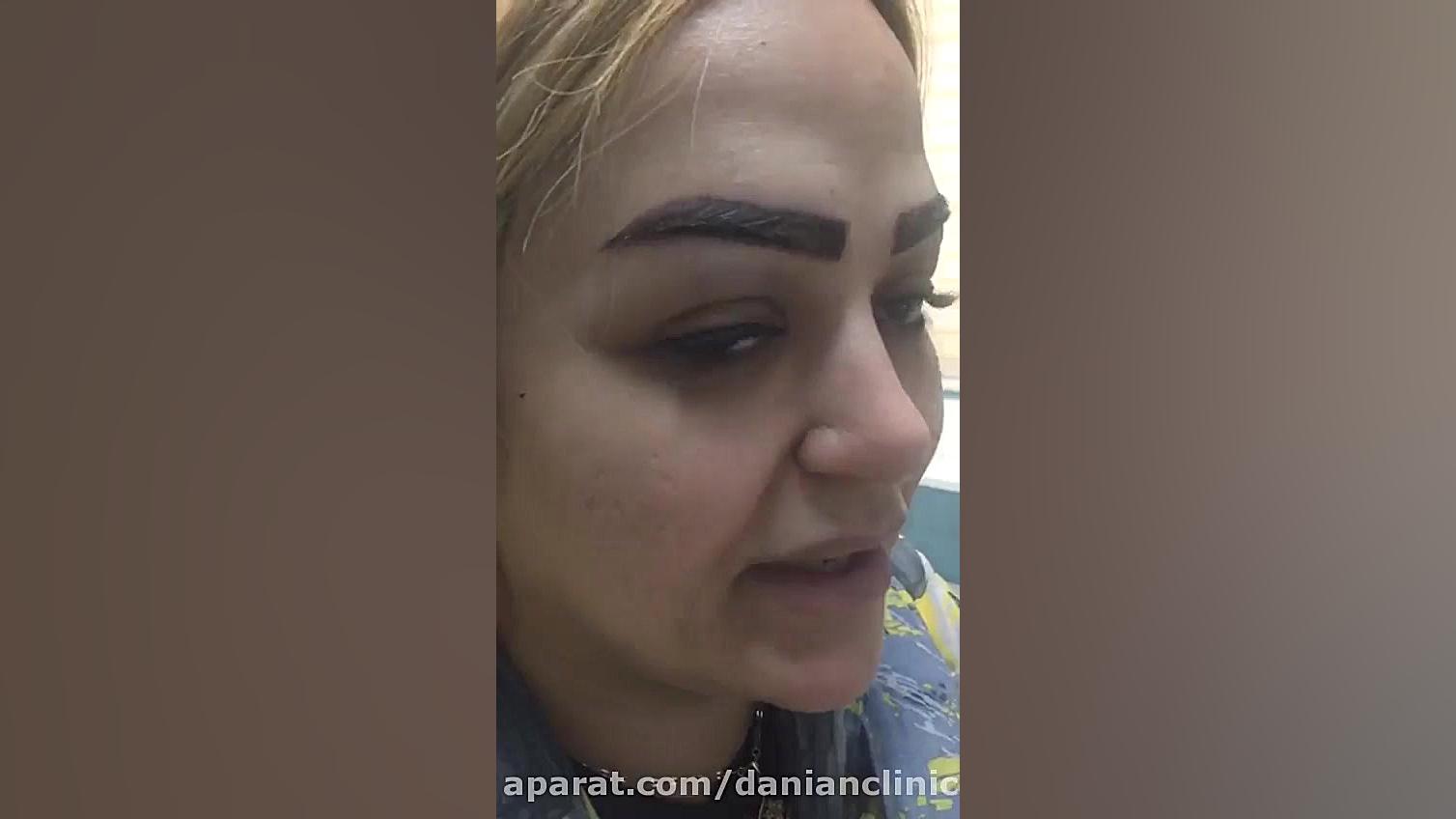 کاشت ابرو طبیعی SVR