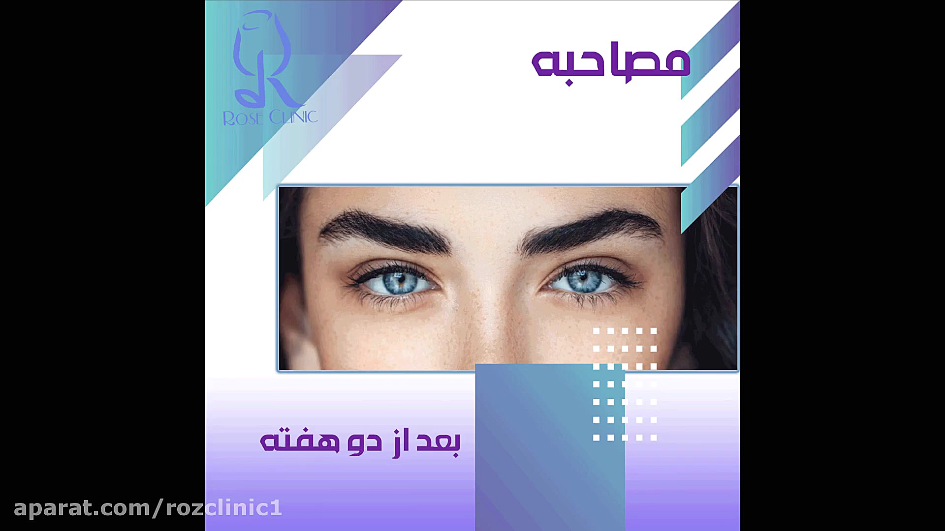 کاشت ابرو | فیلم کاشت ابرو | کلینیک پوست و مو رز | شماره 128 پزشکی هیپر باریک