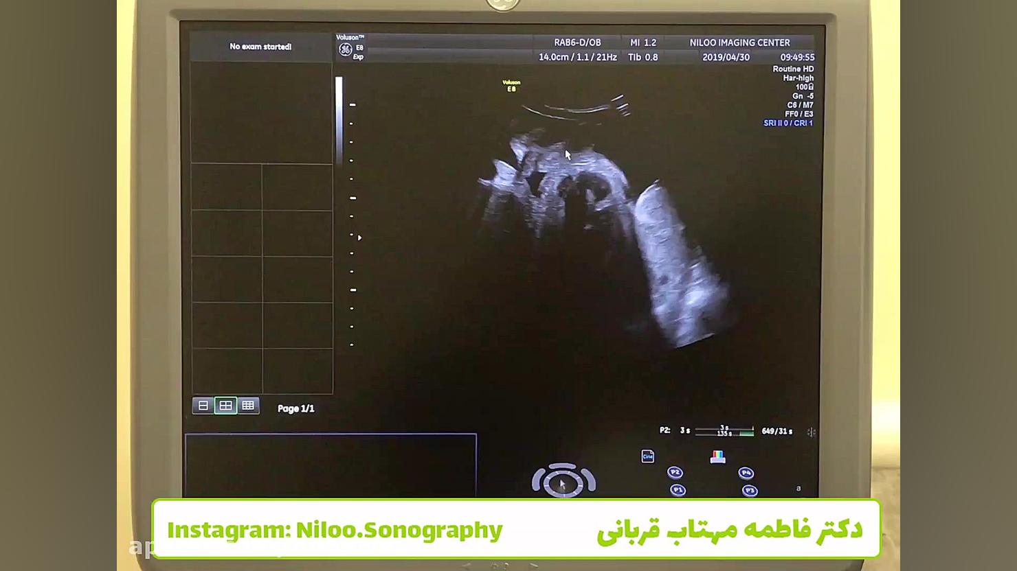 بیضه نهفته - سونوگرافی جنین سونوگرافی نیلو دکتر فاطمه مهتاب قربانی