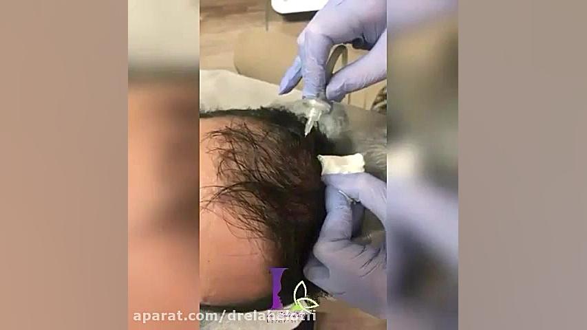 فیلم کربوکسی تراپی مو پلتفرم ارگانوئید انسانی