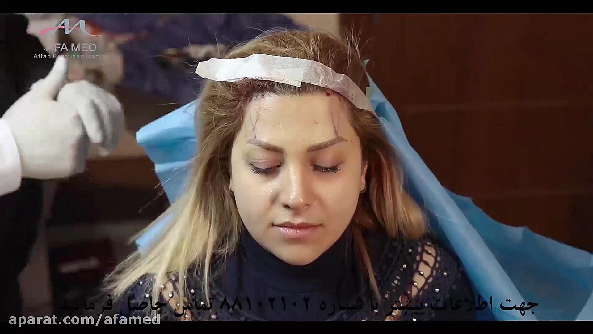 لیفت ابرو با نخ In Situ Hybridization